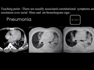 Teaching point : There are usually associated constitutional  symptoms and
resolution over serial  films and  air-bronchogram sign .  
 