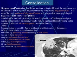 Causes
The opacification is caused by fluid or solid material within the airways that causes a
difference in the relative attenuation of the lung:
transudate, e.g. pulmonary oedema secondary to heart failure
pus, e.g. bacterial pneumonia
blood, e.g. pulmonary haemorrhage
cells, e.g. bronchoalveolar carcinoma
protein, e.g. alveolar proteinosis
fat, e.g. lipoid pneumonia
gastric contents, e.g. aspiration pneumonia
Air space opacification is a descriptive term that refers to filling of the pulmonary tree
with material that attenuates x-rays more than the surrounding lung parenchyma. It is
one of the many patterns of lung opacification and is equivalent to the pathological
diagnosis of pulmonary consolidation.
In radiological studies it presents as increased attenuation of the lung parenchyma
causing obscuration of pulmonary vessels, without significant loss of volume, in the
segment(s) affected. Air bronchograms can also be found 1, 2
.
Consolidation
 