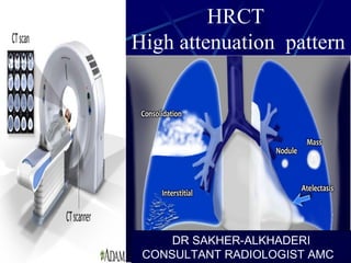 HRCT
High attenuation pattern
DR SAKHER-ALKHADERI
CONSULTANT RADIOLOGIST AMC
 