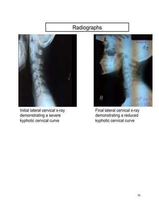 16
Radiographs
Initial lateral cervical x-ray
demonstrating a severe
kyphotic cervical curve
Final lateral cervical x-ray
demonstrating a reduced
kyphotic cervical curve
 