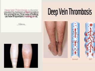 Share_presentation_on_DVT_by_Dr._Monira.pptx