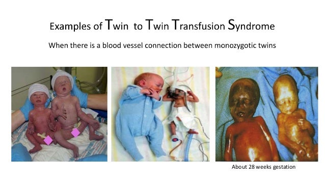 how does genetic twins work how does genetic twins work