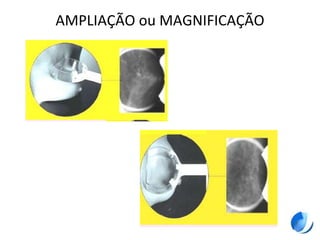 AMPLIAÇÃO ou MAGNIFICAÇÃO
 