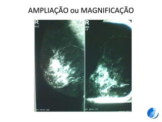 AMPLIAÇÃO ou MAGNIFICAÇÃO
 