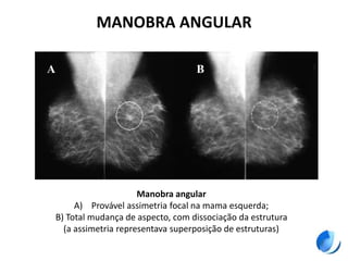 MANOBRA ANGULAR
Manobra angular
A) Provável assimetria focal na mama esquerda;
B) Total mudança de aspecto, com dissociação da estrutura
(a assimetria representava superposição de estruturas)
A B
 