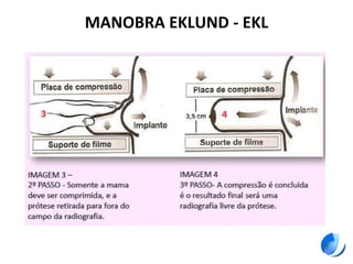 MANOBRA EKLUND - EKL
 