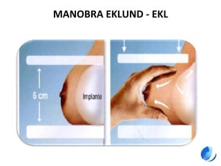 MANOBRA EKLUND - EKL
 