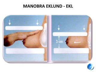 MANOBRA EKLUND - EKL
 