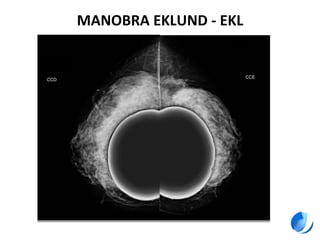 MANOBRA EKLUND - EKL
 