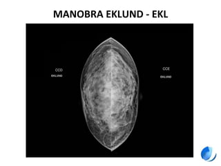 MANOBRA EKLUND - EKL
 
