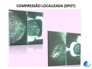 COMPRESSÃO LOCALIZADA (SPOT)
 