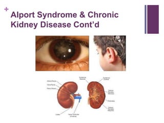 +
Alport Syndrome & Chronic
Kidney Disease Cont’d
 
