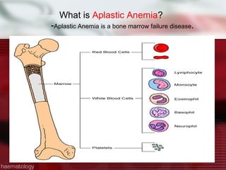 What is  Aplastic Anemia ? - Aplastic Anemia is a bone marrow failure disease . 