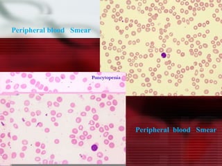 Peripheral blood  Smear  Peripheral  blood  Smear  