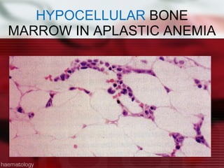 HYPOCELLULAR  BONE MARROW IN APLASTIC ANEMIA 