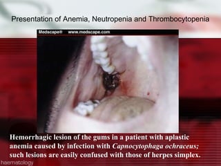 Presentation of Anemia, Neutropenia and Thrombocytopenia Hemorrhagic lesion of the gums in a patient with aplastic anemia caused by infection with  Capnocytophaga ochraceus;  such lesions are easily confused with those of herpes simplex. 