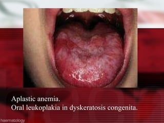 Aplastic anemia. Oral leukoplakia in dyskeratosis congenita. 