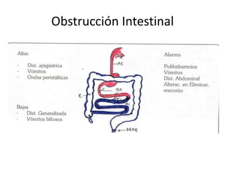 Obstrucción Intestinal
 