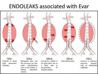 ENDOLEAKS associated with Evar
 