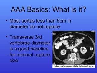 AAA.pptabdominal aortic aneurysms presentation | PPT