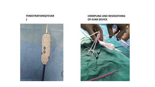 Abdominal aortic aneurysm vascular surgery | PPTX