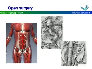 http://www.perfuse.netVascular surgery @ Tallaght
Open surgeryOpen surgery
 