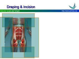 http://www.perfuse.netVascular surgery @ Tallaght
Draping & incisionDraping & incision
 