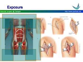 http://www.perfuse.netVascular surgery @ Tallaght
ExposureExposure
 