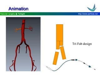 http://www.perfuse.netVascular surgery @ Tallaght
AnimationAnimation
Tri Fab design
 
