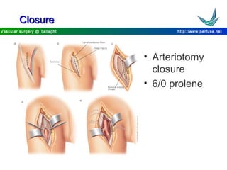 http://www.perfuse.netVascular surgery @ Tallaght
ClosureClosure
• Arteriotomy
closure
• 6/0 prolene
 