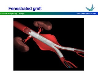 http://www.perfuse.netVascular surgery @ Tallaght
Fenestrated graftFenestrated graft
 