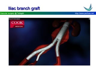 http://www.perfuse.netVascular surgery @ Tallaght
Iliac branch graftIliac branch graft
 