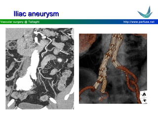 http://www.perfuse.netVascular surgery @ Tallaght
Iliac aneurysmIliac aneurysm
 