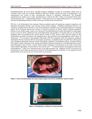 ISSN 2320-5407 International Journal of Advanced Research (2015), Volume 3, Issue 11, 1566 – 1570
1568
Histopathologically, the lesion shows stratified squamous epithelium covering an exceedingly cellular mass of
connective tissue made up of plump fibroblasts, fibrocytes, fibrillar stroma and areas of mineralization. The
mineralization may consist of bone, cementum-like material or dystrophic calcifications. The dystrophic
calcifications are usually seen in early, ulcerated lesions, whereas the older, mature, non-ulcerated lesions show
well-formed bone and cementum-like material.12
The present case was a long standing lesion of 1 year duration,
showing histopathological features of POF consisting of cementum like calcifications.
POF has to be differentiated from traumatic fibroma, peripheral giant cell granuloma, pyogenic granuloma, and
peripheral odontogenic fibroma, since all these lesions present similarly. Peripheral odontogenic fibroma is an
uncommon neoplasm that is believed to arise from odontogenic epithelial rests in periodontal ligament or attached
gingiva itself. Traumatic fibroma has a history of trauma or presence of chronic irritants. Pyogenic granuloma
presents as soft, friable nodule, small in size, having lot of proliferating blood vessels and tendency to hemorrhage.
It may or may not show calcifications but tooth displacement and resorption of alveolar bone are not observed.
Peripheral giant cell granuloma has clinical features similar to POF, however POF lacks the purple or blue
discoloration commonly associated with peripheral giant cell granuloma and radiographically shows flecks of
calcification.12
It is possible to histologically differentiate POF from peripheral giant cell granuloma, peripheral
odontogenic fibroma, traumatic fibroma and pyogenic granuloma, as peripheral giant cell granuloma contains giant
cells, peripheral odontogenic fibroma contains odontogenic epithelium and dysplastic dentine, traumatic fibroma
shows dense cellular connective tissue stroma and pyogenic granuloma presents lot of proliferating blood vessels
and inflammatory cells. In POF, a cellular fibrous stroma consisting of calcifications in the center of the lesion
which could be dystrophic, cemetum like or bone will be seen.12,16
Treatment includes local surgical excision and
oral prophylaxis.17
Follow up is essential because of the high recurrence rate.2
Diagnosis of POF was arrived at in
the present case after ruling out other lesions, based on the histopathological examination. It was surgically excised
and the follow up of one year till now has not shown any recurrence.
Figure 1: Intra-oral photograph showing irregular gingival growth in mandibular anterior region
Figure 2: Photograph revealing the excised specimen
 