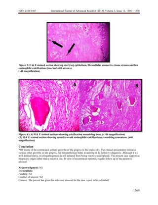 ISSN 2320-5407 International Journal of Advanced Research (2015), Volume 3, Issue 11, 1566 – 1570
1569
Figure 3: H & E stained section showing overlying epithelium, fibrocellular connective tissue stroma and few
eosinophilic calcifications (marked with arrows).
(x40 magnification)
Figure 4: (A) H & E stained sections showing calcification resembling bone. (x100 magnification)
(B) H & E stained section showing round to ovoid eosinophilic calcifications resembling cementum. (x40
magnification)
Conclusion
POF is one of the commonest solitary growths of the gingiva in the oral cavity. The clinical presentation mimicks
various other growths on the gingiva, but histopathology helps in arriving at its definitive diagnosis. Although it is a
well defined entity, its etiopathogenesis is still debated from being reactive to neoplastic. The present case supports a
neoplastic origin rather than a reactive one. In view of recurrences reported, regular follow up of the patient is
advised.
Acknowledgment: Nil
Declarations
Funding: Nil
Conflict of interest: Nil
Consent: The patient has given his informed consent for the case report to be published.
 
