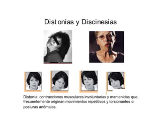 Dist onias y Discinesias 
Distonía: contracciones musculares involuntarias y mantenidas 
frecuentemente originan movimientos repetitivos y torsionantes 
posturas anómalas. 
que, 
o 
 