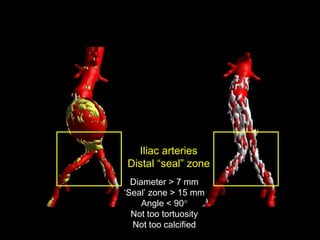 Iliac arteries
Distal “seal” zone
Diameter > 7 mm
‘Seal’ zone > 15 mm
Angle < 90°
Not too tortuosity
Not too calcified
 