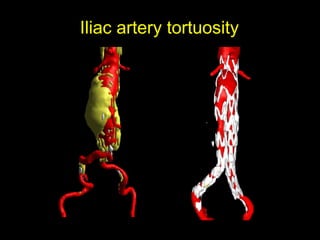 Iliac artery tortuosity
 