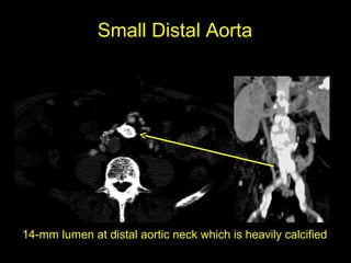 Small Distal Aorta
14-mm lumen at distal aortic neck which is heavily calcified
 