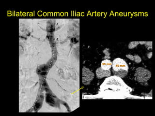 40 mm40 mm20 mm20 mm
Bilateral Common Iliac Artery Aneurysms
 
