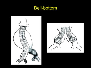 Bell-bottom
 