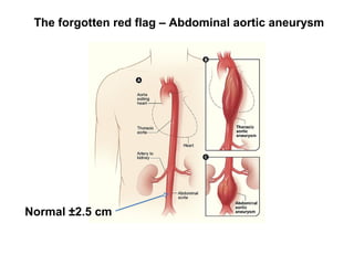 Normal ±2.5 cm
The forgotten red flag – Abdominal aortic aneurysm
@TaylorAlanJ
 