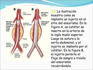 (11)  La ilustración muestra como se implanta un injerto en el sitio del aneurisma. En la figura A, un catéter se inserta en la arteria de la ingle muslo superior. Luego se sutura a la aorta abdominal, y el injerto se implanta por el catéter. En la figura B, el injerto permite el flujo de sangre a través del aneurisma recubriéndolo   