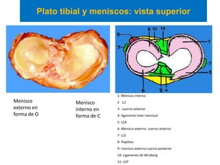 Plato tibial y meniscos: vista superior




                               1- Menisco interno
Menisco           Menisco      2- LLI
externo en        interno en   3- cuerno anterior
forma de O        forma de C   4- ligamento inter meniscal
                               5- LCA
                               6- Menisco externo cuerno anterior
                               7- LLE
                               8- Poplíteo
                               9- menisco externo cuerno posterior
                               10- Ligamento de Wrisberg
                               11- LCP
 