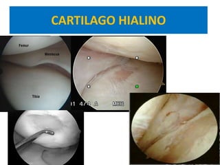 CARTILAGO HIALINO
 