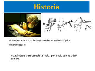Historia



Visión directa de la articulación por medio de un sistema óptico
Watanabe (1954)



  Actualmente la artroscopía se realiza por medio de una video
  cámara.
 