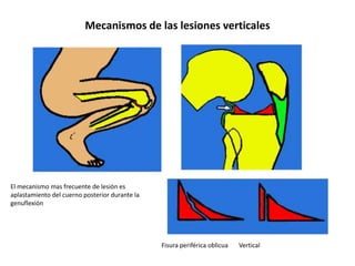 Mecanismos de las lesiones verticales




El mecanismo mas frecuente de lesión es
aplastamiento del cuerno posterior durante la
genuflexión




                                                Fisura periférica oblicua   Vertical
 