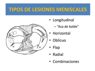 TIPOS DE LESIONES MENISCALES
              • Longitudinal
                – “Asa de balde”
              • Horizontal
              • Oblicuo
              • Flap
              • Radial
              • Combinaciones
 