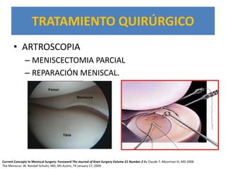 TRATAMIENTO QUIRÚRGICO
       • ARTROSCOPIA
              – MENISCECTOMIA PARCIAL
              – REPARACIÓN MENISCAL.




Current Concepts In Meniscal Surgery: Foreword The Journal of Knee Surgery Volume 21 Number 2 By Claude T. Moorman III, MD 2008
The Meniscus W. Randall Schultz, MD, MS Austin, TX January 17, 2009
 