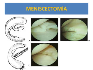 MENISCECTOMÍA
 